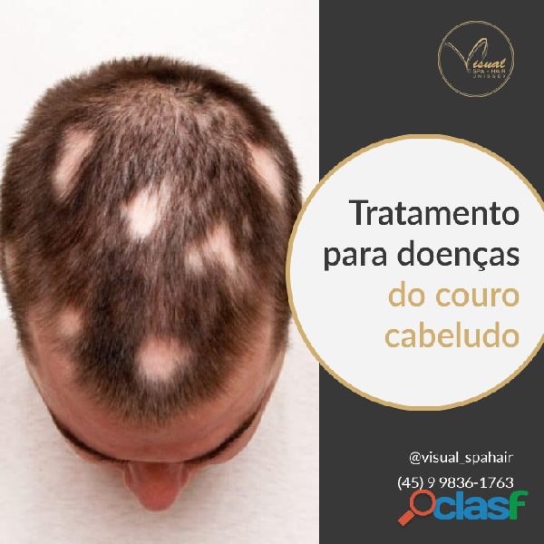 Tratamento para queda de cabelo em Foz do Iguaçu 4